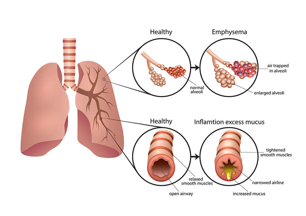 Emphysema & Inflamtion Excess Mucus
