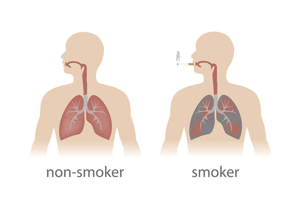 Non-Smoker vs Smoker